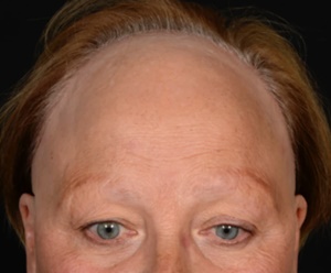 Female Hair Loss FAQ's - Image From Wikipedia - https://en.wikipedia.org/wiki/Frontal_fibrosing_alopecia
