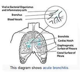 Lung Disease