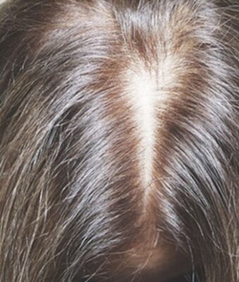 Scalp Micropigmentation (SMP) For Women's Hair Loss