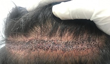 Scalp Micropigmentation (SMP) For Women's Hair Loss