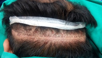 Scalp Micropigmentation (SMP) For Women's Hair Loss