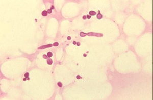 Malassezia A Fungus Which May Cause Dandruff